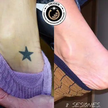 Una estrella negra en el tobillo, antes y después de 8 sesiones.