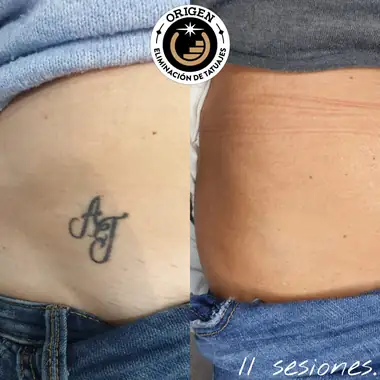 Unas iniciales en la cadera, antes y después de 11 sesiones.