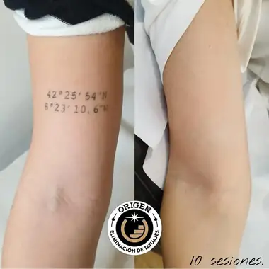 Unas coordenadas en el brazo, antes y después de 10 sesiones.