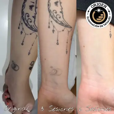Una luna con colgantes en el antebrazo y otro tatuaje pequeño en la muñeca: el original, a las 3 sesiones y a las 6, ya sin tinta.