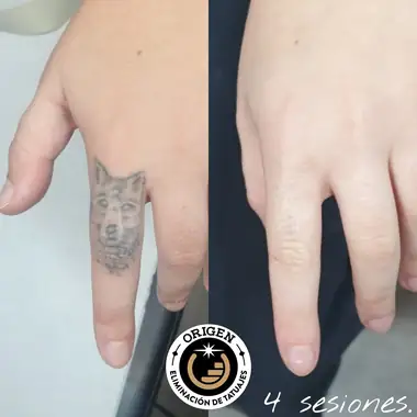 Un lobo pequeño en el dedo, antes y después de 4 sesiones.