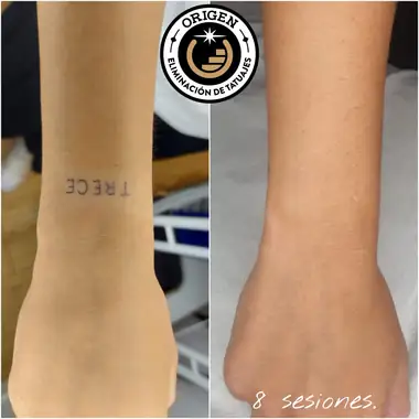 La palabra «TRECE» en la muñeca, antes y después de 8 sesiones.