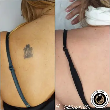 Un tatuaje pequeño en la espalda, junto al tirante, antes y después de 4 sesiones.