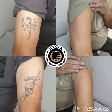 Dos tatuajes antiguos en el brazo, un símbolo y una daga con calavera, antes y después de 9 sesiones.