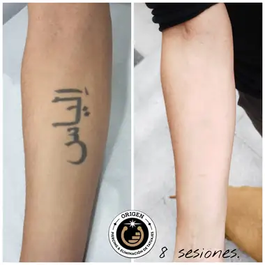 Letras árabes en el antebrazo, antes y después de 8 sesiones.